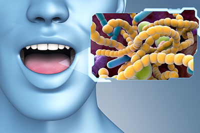 The image shows a 3D rendering of a human mouth with an open mouth, set against a background that includes a microscopic view of bacteria, with a label indicating  Bacteria  and a graphic representation of a person s head.