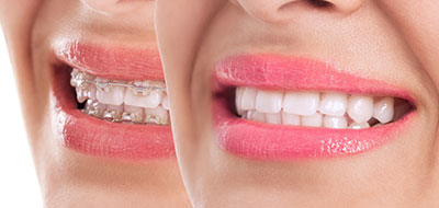 The image shows a woman with a broad smile, showcasing her teeth, which are enhanced by a cosmetic procedure, likely veneers, with a focus on her mouth and teeth against a neutral background.