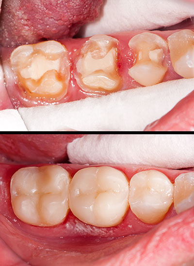 The image shows a close-up of an open mouth with visible teeth, gums, and tongue, displaying a dental procedure or condition in progress.