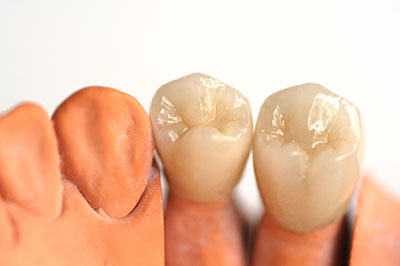 The image shows two sets of artificial teeth, one with a full set and the other with a partial set, displayed against a white background.