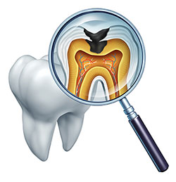 An illustration showing a close-up view of a tooth with an open cavity, viewed through a magnifying glass, with a microscopic image inside the glass depicting the interior of the tooth with a visible nerve and blood vessels.