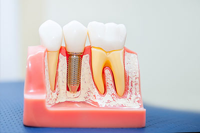 Dental model with teeth and gums, showcasing dental implants and bridges.