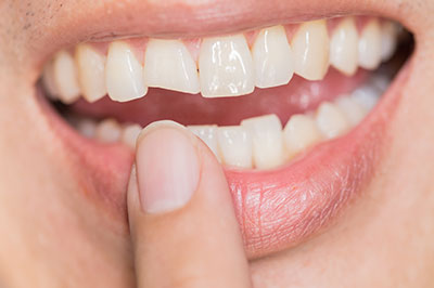 The image shows a person with their mouth open, holding a finger up to their lip, revealing a large gap between their teeth.