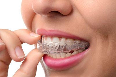 The image shows a person with their teeth clenched together while holding a toothbrush, displaying an orthodontic appliance such as braces or aligners.