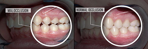 The image shows a side-by-side comparison of two dental implants with labels indicating  malocclusion  on one side and  normal occlusion  on the other, highlighting the difference between an improperly aligned set of teeth and a properly aligned set in a close-up view.