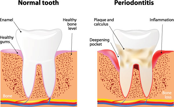 The image is a medical illustration showing a normal tooth on the left, an enamel-eroded tooth in the center with text indicating  periodontitis,  and a severely damaged tooth on the right with labels such as  healthy gum line,   deepening pocket,  and  bone loss.