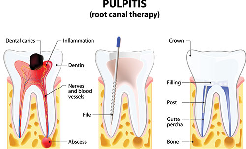 The image displays a diagrammatic illustration of a dental pulpitis with labeled parts such as  root canal,   dental caries,   inflammation,   crown,  and  file.  It shows a tooth with internal decay, a visible root canal, and an affected area surrounded by inflamed tissue. The image is educational, likely used in medical or dental contexts to explain the condition of pulpitis.