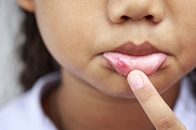 The image shows a close-up view of a person s face with an acne treatment applied on their skin, focusing on the area around the lips.