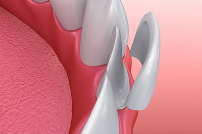 The image shows a close-up view of a dental implant with a metal screw visible on top of a pink gum, set against a red background.