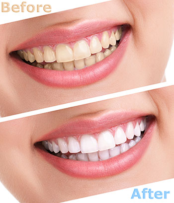 The image shows a before-and-after comparison of a person s teeth after cosmetic dental treatment, highlighting a transformation from yellowed to white teeth.